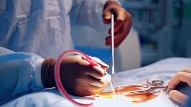 Operacja Pacjencie Ręce Chirurga Rękawiczkach Ochronnych Wykonują Operacje Narzędziami Medycznymi — Wideo stockowe