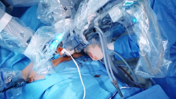 Equipamento Contemporâneo Durante Cirurgia Parte Máquina Dispositivo Robótico Corpo Paciente — Vídeo de Stock