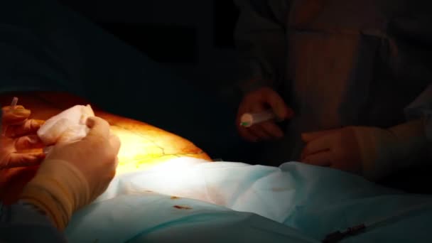 Chirurgia Plastyczna Brzucha Chirurg Zespołowy Sali Operacyjnej Nowoczesne Wyposażenie Sali — Wideo stockowe
