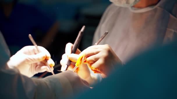 外科手術 腹腔鏡検査 オペレーティングテーブルの患者を閉じます 腹部からの脂肪組織の外科的除去 — ストック動画