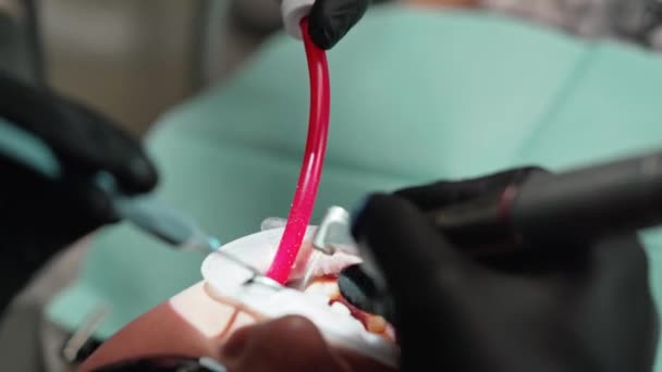 Dişçi Kliniğinde Diş Tedavisi Sırasında Hastanın Yüzü Elleri Siyah Eldivenli — Stok video