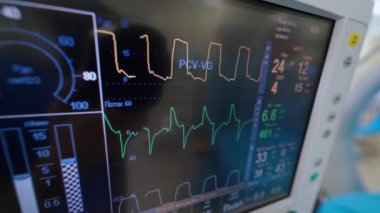 Hastanın durumu monitör arka planında. Hastanede yapay akciğer havalandırma cihazı var. Modern cihaz akciğerlerin çalışmasını gösteriyor. Yakın plan. Salgın.
