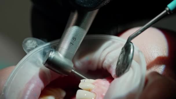 Рот Пациента Время Лечения Зубов Руки Дантиста Работают Стоматологическими Инструментами — стоковое видео