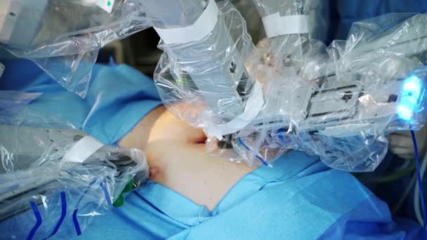 Csúcstechnológiás Orvosi Felszerelés Műtőben Sebészeti Robot Robotkarjai Beteg Testében Technológia — Stock videók