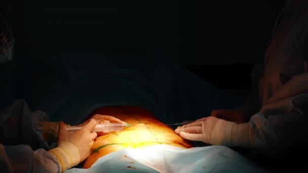 腹部的腹部整形术 部分切除腹部的脂肪和粘液组织 医生切了一把激光手术刀 — 图库视频影像