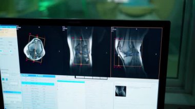 Tıbbi kontrol odasındaki monitörde röntgen fotoğrafları var. Hastanedeki bir bilgisayarın ekranında hastanın kemiklerini inceleyen bir doktor. Yakın plan..
