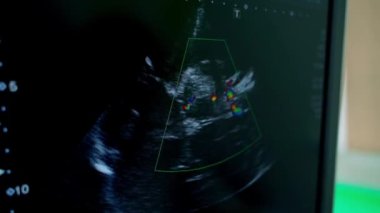 Ultrason görüntüleri bir bilgisayarın ekranında. Monitör, klinikte hastanın organlarının ultrason muayenesini gösteriyor..