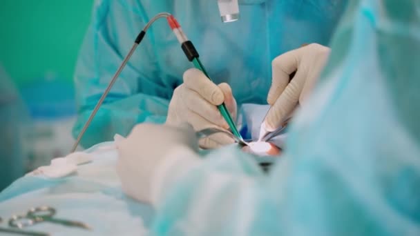 専門家による外科手術手順 無菌手袋の医師の手は 医療機器を使用した手術を行います クローズアップ — ストック動画