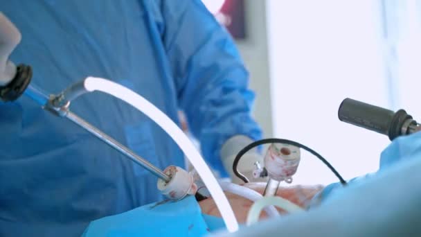手術中の患者さんの医療機器 医師は手術室で現代の手術器具を使った手術を行う クローズアップ — ストック動画