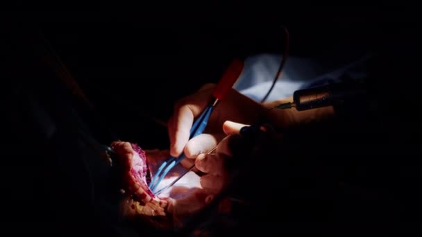 Operacja Laparoskopowa Ciemnym Tle Ręce Rękawiczkach Chirurgicznych Wykonują Neurochirurgię Pomocą — Wideo stockowe