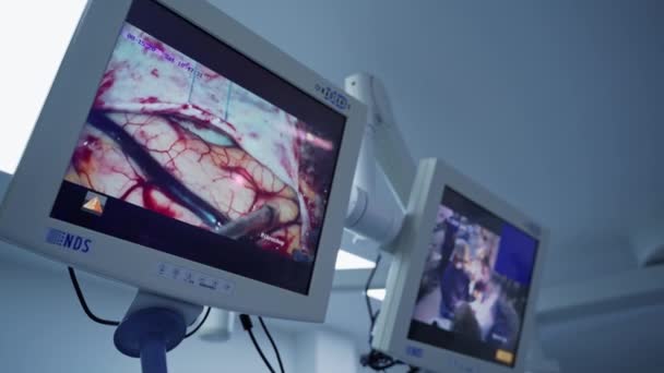 Νευροχειρουργική Διαδικασία Εμφανίζεται Στην Οθόνη Μοντέρνος Εξοπλισμός Στο Χειρουργείο Επίδειξη — Αρχείο Βίντεο