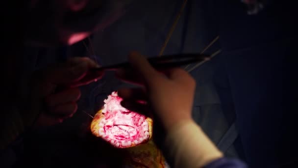 Órgano Interno Paciente Durante Neurocirugía Las Manos Los Médicos Utilizan — Vídeo de stock