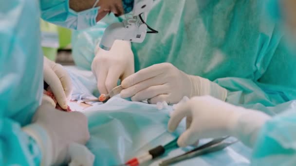 Műtét Betegen Kezek Steril Kesztyűben Sebészeti Eszközökkel Műtét Alatt Orvosokból — Stock videók