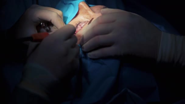 Kobiece Powieki Podczas Operacji Plastycznej Dłonie Lekarza Białych Rękawiczkach Wykonujące — Wideo stockowe