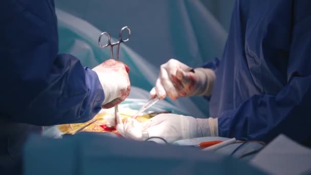 Chirurg Pracy Sali Operacyjnej Grupa Chirurgów Wykonujących Operacje Sali Operacyjnej — Wideo stockowe