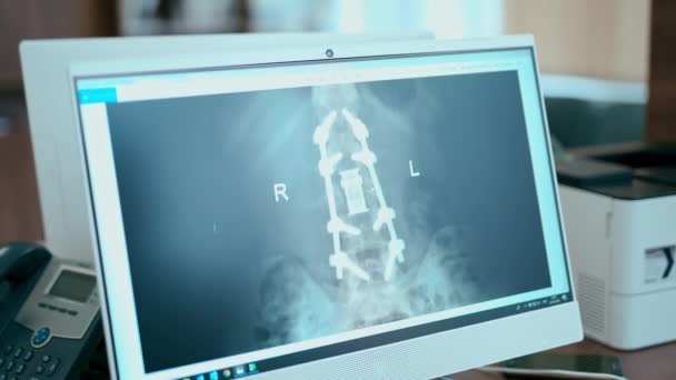 Radiografía Del Paciente Imagen Rayos Pantalla Clínica — Vídeos de Stock