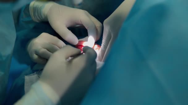 Kozmetikai Plasztikai Sebészet Sebész Csoport Plasztikai Sebészeti Klinikán Végzi Műtétet — Stock videók