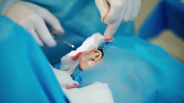 Műtéti Sebész Kezek Fül Kozmetikai Műtétjeinek Közelsége — Stock videók