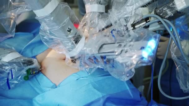 Operační Systém Vinci Manipulátoři Provádějící Chirurgii Pacienta — Stock video