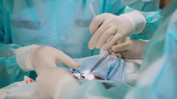 进行外科手术的医疗小组医院手术室的外科医生小组 — 图库视频影像