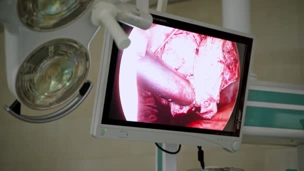 Opération Chirurgicale Avec Équipement Laparoscopique Processus Opération Chirurgie Gynécologique Aide — Video