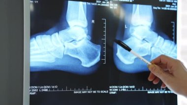 Doktor ayak röntgenine bakıyor. Uzman, ayak röntgeni film izleyicisinin görüntülerini izliyor.