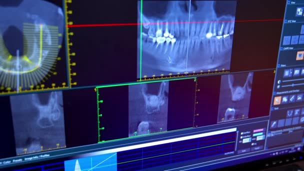 Röntgen Der Mundhöhle Mit Zähnen Nahaufnahme Der Digitalen Orthopantomographie Zur — Stockvideo