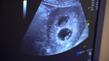 Sonografi. Ultrason makinesinin ekranı. Ekrandaki ultrason sonuçları. Sağlık hizmeti kavramı.