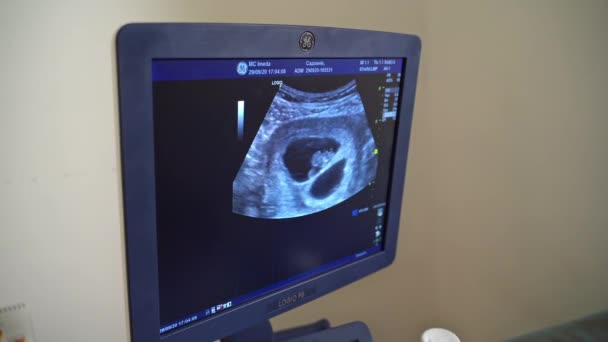 Ultrahang Letapogatás Emberről Monitoron Szonográfia Ultrahangos Gép Képernyője Egészségügyi Koncepció — Stock videók