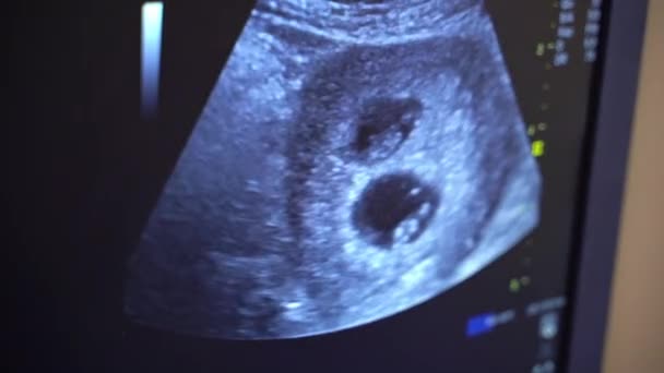 Sonography Screen Ultrasound Machine Results Ultrasound Monitor Health Care Concept — Stock Video