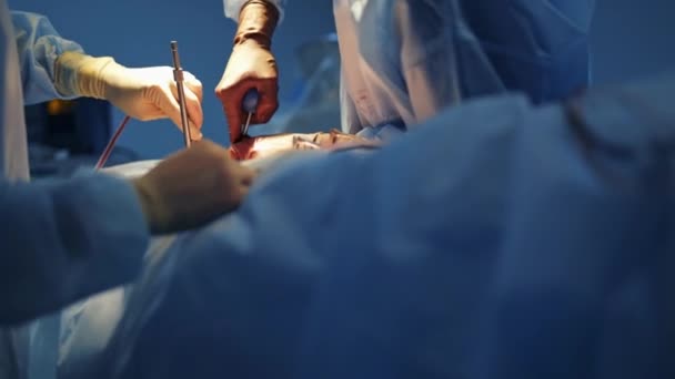 Moderne Ausstattung Operationssaal Teamchirurg Bei Der Arbeit Operationssaal Chirurg Operationssaal — Stockvideo