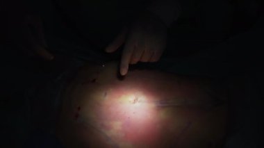 Bir plastik cerrah liposuction ve liposculpture ameliyatını gerçekleştirir. Doktor, karanlık ameliyathanede liposuction prosedürü için özel bir araç kullanıyor..