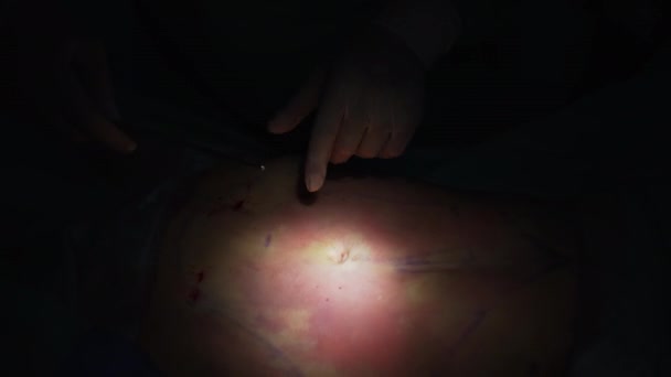 整形外科医生进行抽脂和脱脂的手术 医生在黑暗手术室使用特殊的吸脂工具 — 图库视频影像