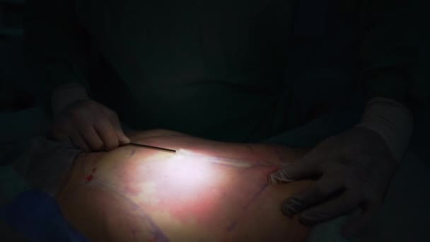 Dokter Bedah Membuat Operasi Sedot Lemak Perut Pasien Liposuction Perut — Stok Video