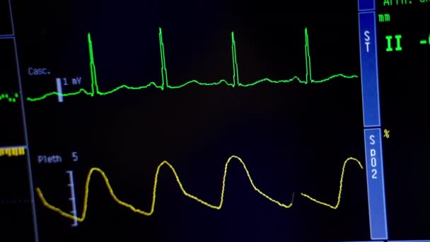 Srdeční Monitor Nemocničním Divadle Monitorovat Srdeční Frekvenci Pro Chirurgii Operačním — Stock video