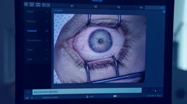 Göz cerrahisi sırasında hasta. Doktor ekipmanla gözündeki kisti çıkarır.