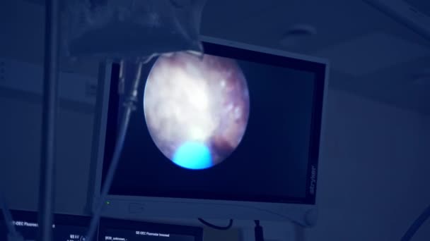 在手术过程中对病人进行监测 在现代手术室进行外科手术的医疗队 — 图库视频影像