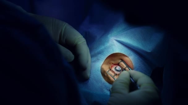 Pacjent Pod Mikroskopem Chirurgicznym Pacjent Chirurg Sali Operacyjnej Podczas Operacji — Wideo stockowe