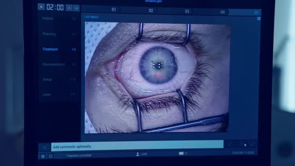 眼科手术中的病人医生带着器械摘除眼睛中的囊肿 — 图库视频影像