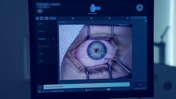 Офтальмолог Оперирует Глаз Пациента Медицинские Работники Наблюдают Операцией Глазах Через — стоковое видео