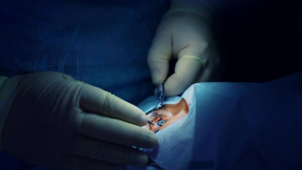 Laserzicht Correctie Operatie Operatieoog Van Chirurg Operatiekamer — Stockvideo