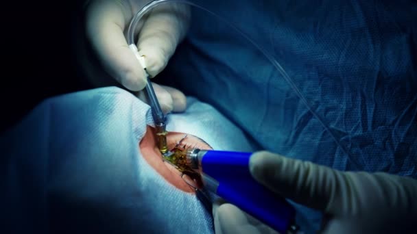 Chirurg Der Augenoperationen Durchführt Augenarzt Operiert Auge Des Patienten Klinik — Stockvideo
