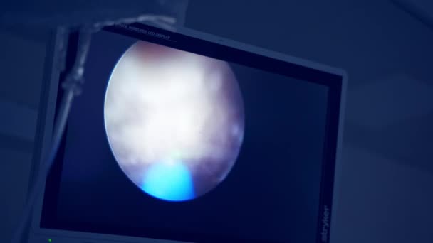 Équipe Médicale Effectuant Une Laparoscopie Chirurgien Opérant Travaillant Avec Des — Video
