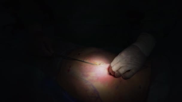 Zbliż Szczegóły Operacji Zbliżenie Chirurga Pomocą Narzędzia Chirurgicznego Sali Operacyjnej — Wideo stockowe