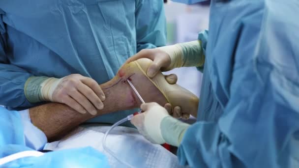 Műtét Beteg Lábán Orvosok Orvosi Egyenruhában Műtétet Végeznek Sebészeti Eszközökkel — Stock videók