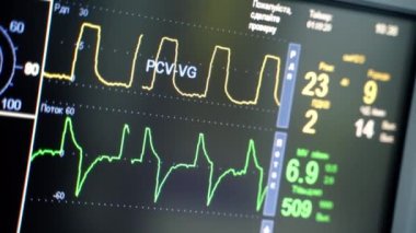 Kalp atış hızı monitöründeki grafikler. Tıbbi monitör ameliyathanede bir hastanın hayati belirtilerini gösteriyor. Yakın plan..