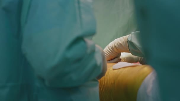 Chirurgischer Eingriff Krankenhaus Ärztliche Hände Handschuhen Operieren Einen Kranken Patienten — Stockvideo