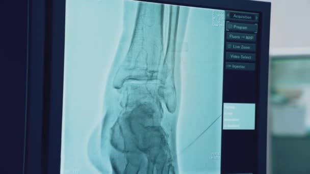 Kości Pacjenta Wyświetlane Monitorze Szpitalnym Rezonans Magnetyczny Diagnostyka Choroby Specjalny — Wideo stockowe