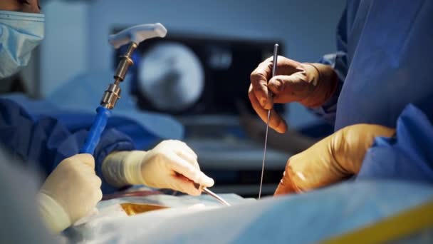 手术过程中医生手中的手术器械 外科医生和戴防护手套的助手为病人做手术 后续行动 — 图库视频影像