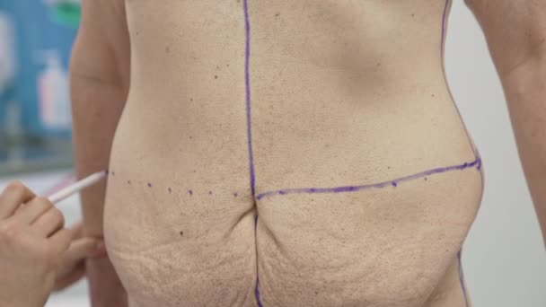 医師は患者の腹の問題領域を示しています 手術のための腹部を示す準備の男性の体 クローズアップ 減量の結果 — ストック動画